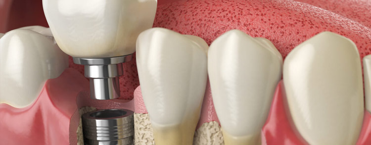 full mouth dental implants wollongong