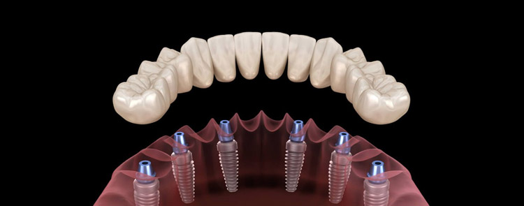 dental implants wollongong